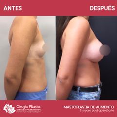 Aumento mamas - Dr. Emmanuel Manavela Chiapero