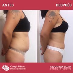 Abdominoplastia - Dr. Emmanuel Manavela Chiapero