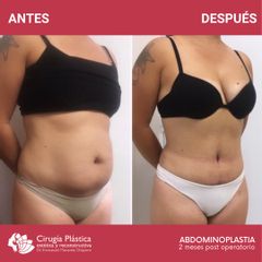 Abdominoplastia - Dr. Emmanuel Manavela Chiapero