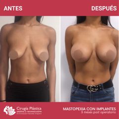Mastopexia - Dr. Emmanuel Manavela Chiapero