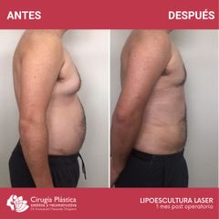 Lipoescultura - Dr. Emmanuel Manavela Chiapero