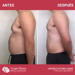 Lipoescultura - Dr. Emmanuel Manavela Chiapero