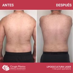 Lipoescultura - Dr. Emmanuel Manavela Chiapero