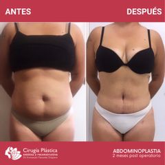 Abdominoplastia - Dr. Emmanuel Manavela Chiapero