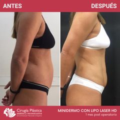Dermolipectomía - Dr. Emmanuel Manavela Chiapero