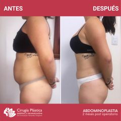 Abdominoplastia - Dr. Emmanuel Manavela Chiapero