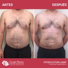 Lipoescultura - Dr. Emmanuel Manavela Chiapero