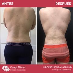 Lipoescultura - Dr. Emmanuel Manavela Chiapero
