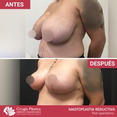 Reducción de mamas - Dr. Emmanuel Manavela Chiapero