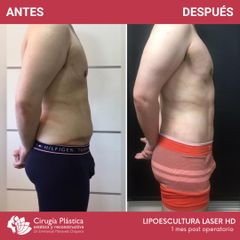 Lipoescultura - Dr. Emmanuel Manavela Chiapero