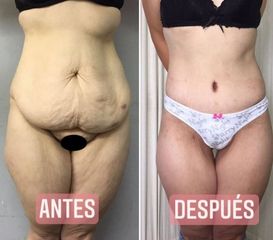 Abdominoplastia - Dr. Emmanuel Manavela Chiapero