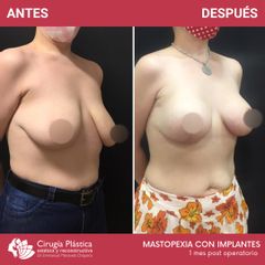 Mastopexia - Dr. Emmanuel Manavela Chiapero