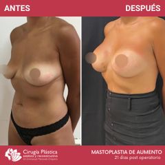Aumento mamas - Dr. Emmanuel Manavela Chiapero