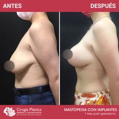 Mastopexia - Dr. Emmanuel Manavela Chiapero