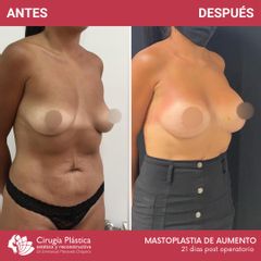 Aumento mamas - Dr. Emmanuel Manavela Chiapero