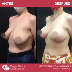 Mastopexia - Dr. Emmanuel Manavela Chiapero
