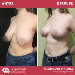 Reducción de mamas - Dr. Emmanuel Manavela Chiapero