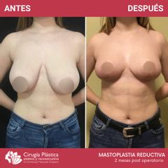 Reducción de mamas - Dr. Emmanuel Manavela Chiapero