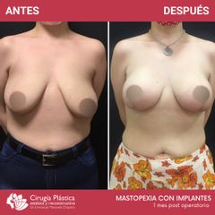 Mastopexia - Dr. Emmanuel Manavela Chiapero