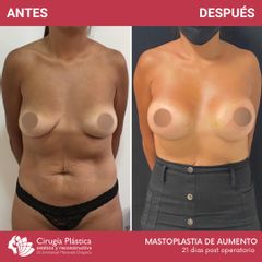 Aumento mamas - Dr. Emmanuel Manavela Chiapero