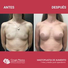 Aumento mamas - Dr. Emmanuel Manavela Chiapero