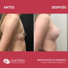 Aumento mamas - Dr. Emmanuel Manavela Chiapero
