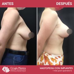 Mastopexia - Dr. Emmanuel Manavela Chiapero