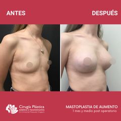 Aumento mamas - Dr. Emmanuel Manavela Chiapero