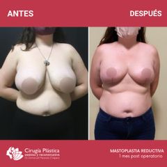 Reducción de mamas - Dr. Emmanuel Manavela Chiapero