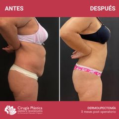 Dermolipectomía - Dr. Emmanuel Manavela Chiapero