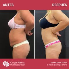 Dermolipectomía - Dr. Emmanuel Manavela Chiapero