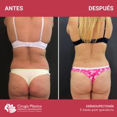 Dermolipectomía - Dr. Emmanuel Manavela Chiapero
