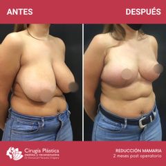 Reducción de mamas - Dr. Emmanuel Manavela Chiapero
