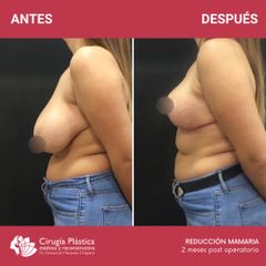 Reducción de mamas - Dr. Emmanuel Manavela Chiapero