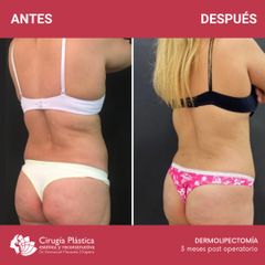 Dermolipectomía - Dr. Emmanuel Manavela Chiapero