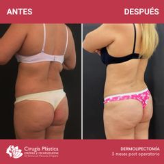 Dermolipectomía - Dr. Emmanuel Manavela Chiapero