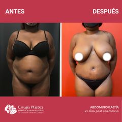 Abdominoplastia - Dr. Emmanuel Manavela Chiapero