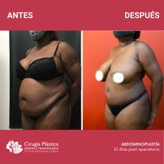 Abdominoplastia - Dr. Emmanuel Manavela Chiapero