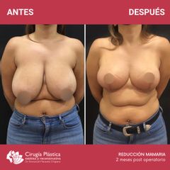 Reducción de mamas - Dr. Emmanuel Manavela Chiapero
