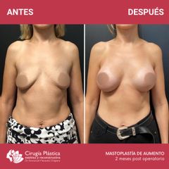 Aumento mamas - Dr. Emmanuel Manavela Chiapero