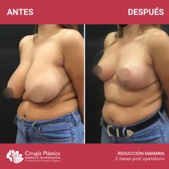 Reducción de mamas - Dr. Emmanuel Manavela Chiapero