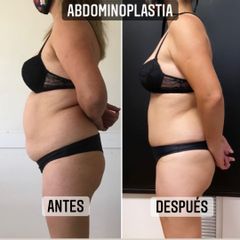 Abdominoplastia - Dr. Emmanuel Manavela Chiapero
