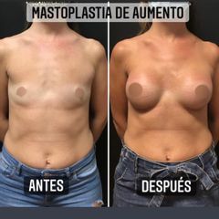 Aumento mamas - Dr. Emmanuel Manavela Chiapero