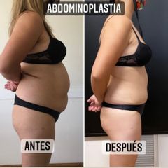Abdominoplastia - Dr. Emmanuel Manavela Chiapero