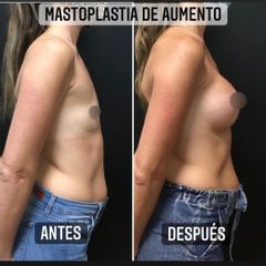 Aumento mamas - Dr. Emmanuel Manavela Chiapero