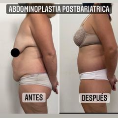 Abdominoplastia - Dr. Emmanuel Manavela Chiapero