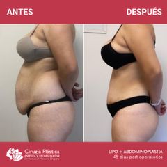 Liposucción - Dr. Emmanuel Manavela Chiapero