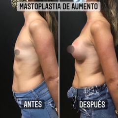 Aumento mamas - Dr. Emmanuel Manavela Chiapero