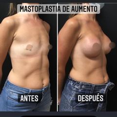 Aumento mamas - Dr. Emmanuel Manavela Chiapero