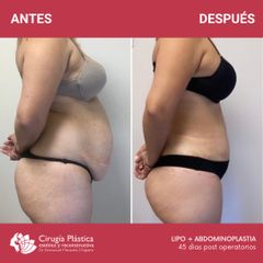 Liposucción - Dr. Emmanuel Manavela Chiapero
